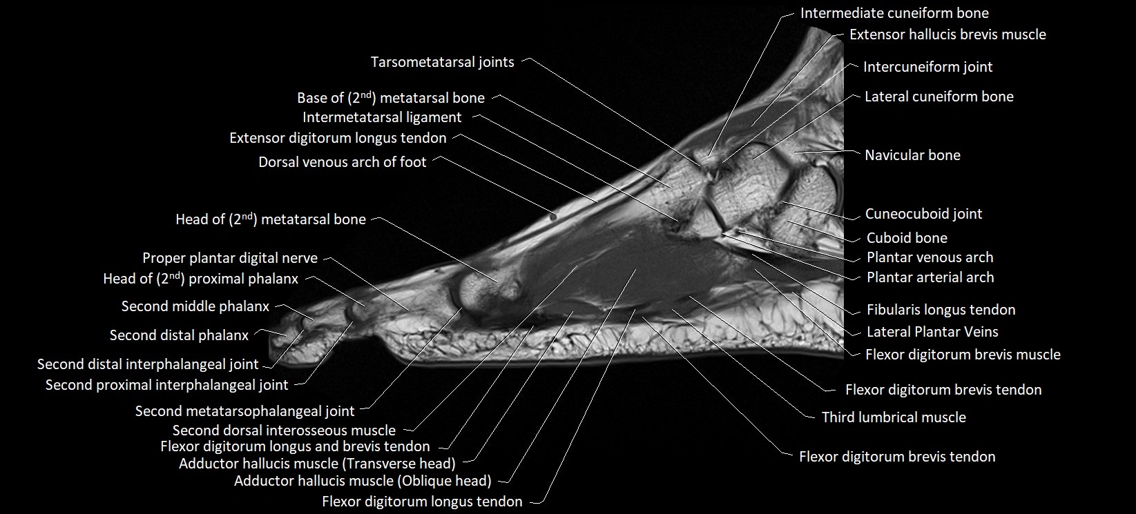 MRI foot sagittal labelled cross sectional anatomy image  14.webp